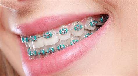 ortho metal brackets|traditional metal braces for adults.